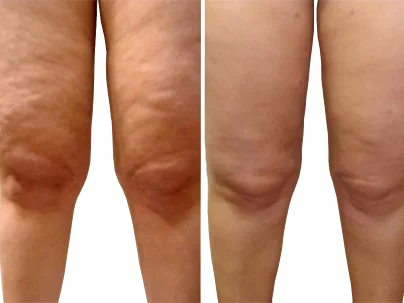 52 years old, Severe cellulite, loss of skin elasticity, soreness. Visible pleats above the knees. Loose skin.