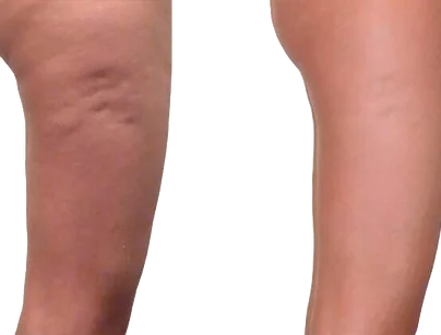 25 years, Cellulitis at the initial stage, the growth of scar tissue in the upper thigh