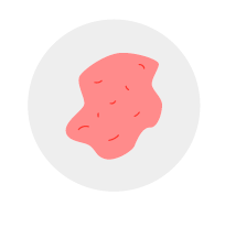 Without hematomas (bruises)